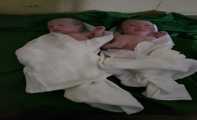Halimah’s twins a few minutes after their birth ©BFD/UNFPA Yemen 